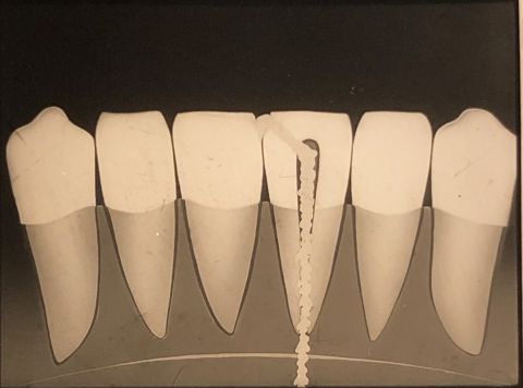 Kalodent