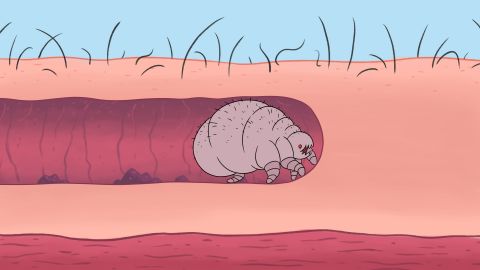 Clipphanger: What is Scabies?